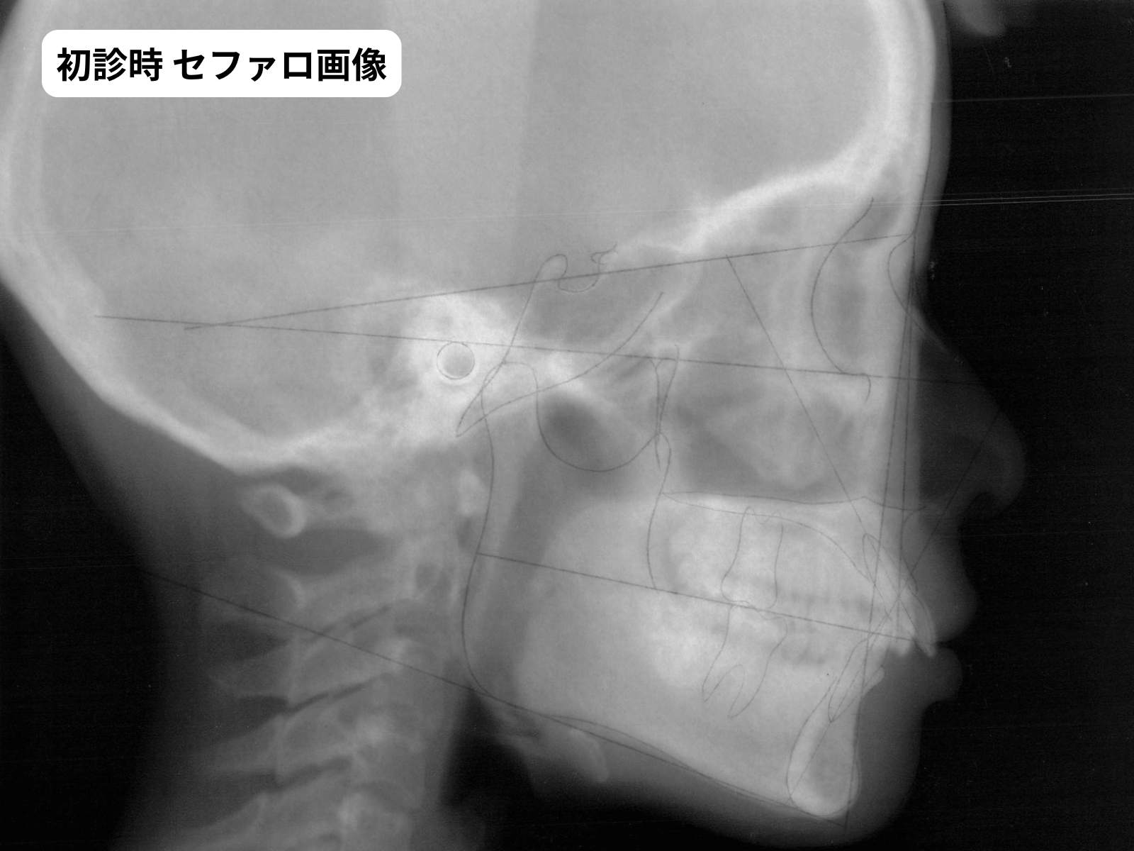 初診時セファロトレース｜ローアングル骨格判定｜奈良の矯正歯科