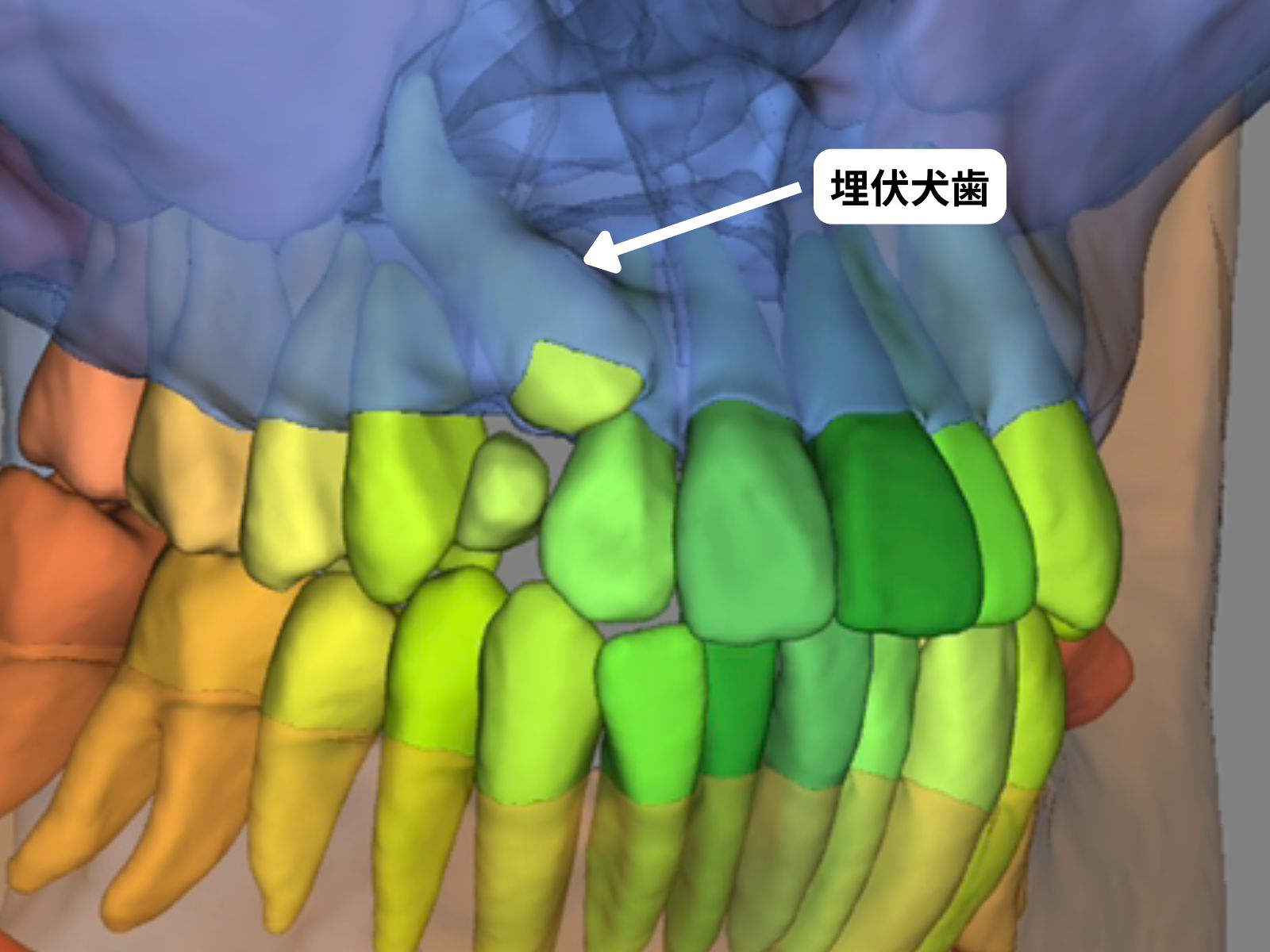 右上犬歯埋伏のCT 3D画像｜奈良の矯正歯科 氏井矯正歯科クリニック