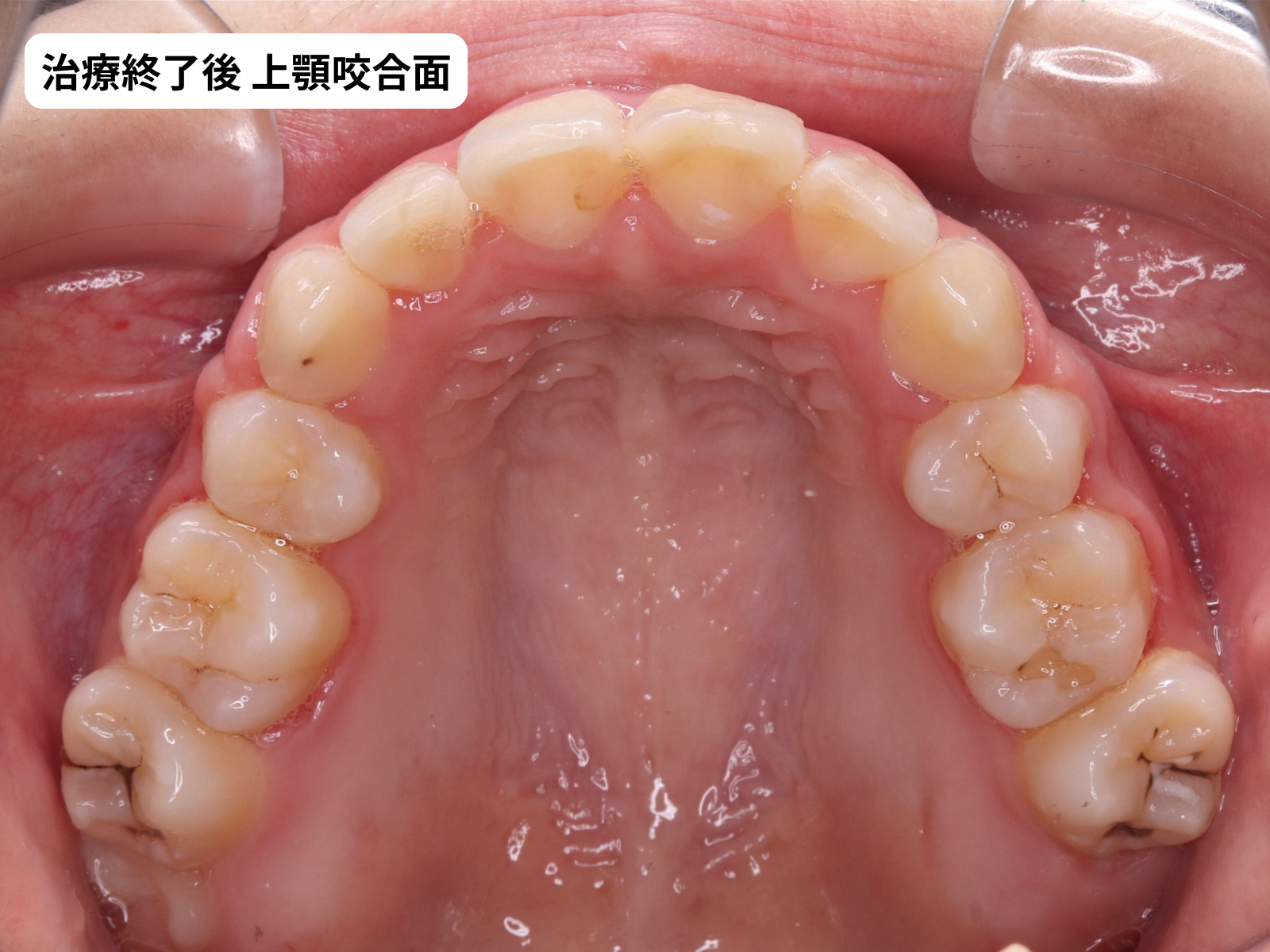 矯正治療後の上顎咬合面｜でこぼこ改善症例・奈良の矯正歯科