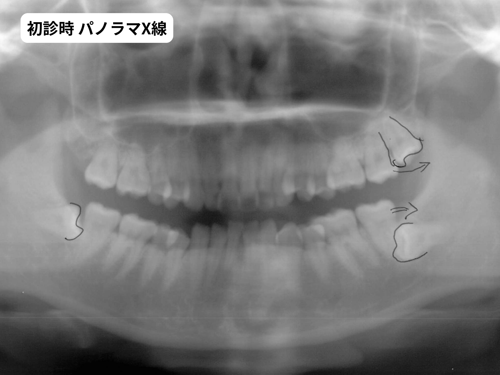 初診時パノラマX線｜右下1番先天欠如｜奈良の矯正歯科