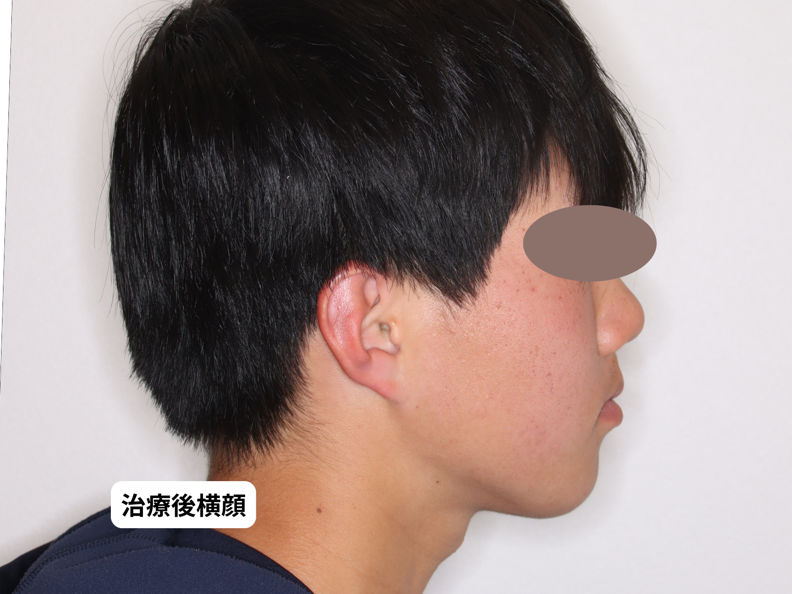 犬歯埋伏 治療前後 横顔｜奈良の矯正歯科 氏井矯正歯科クリニック