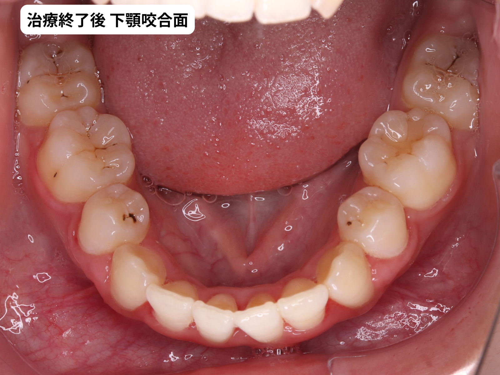 矯正治療後の下顎咬合面｜でこぼこ改善症例・奈良の矯正歯科