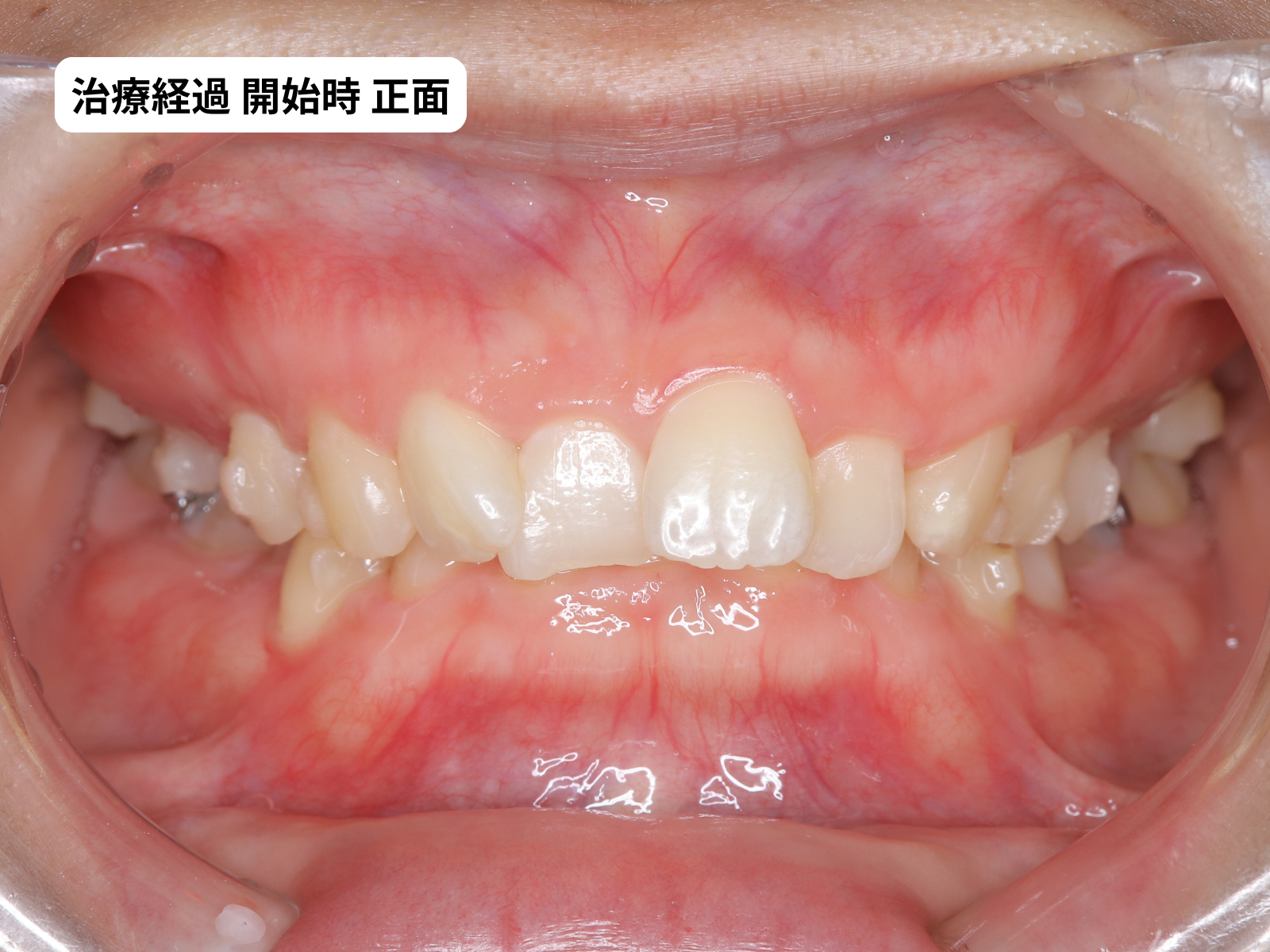 矯正治療開始時の正面｜重度過蓋咬合｜奈良の矯正歯科