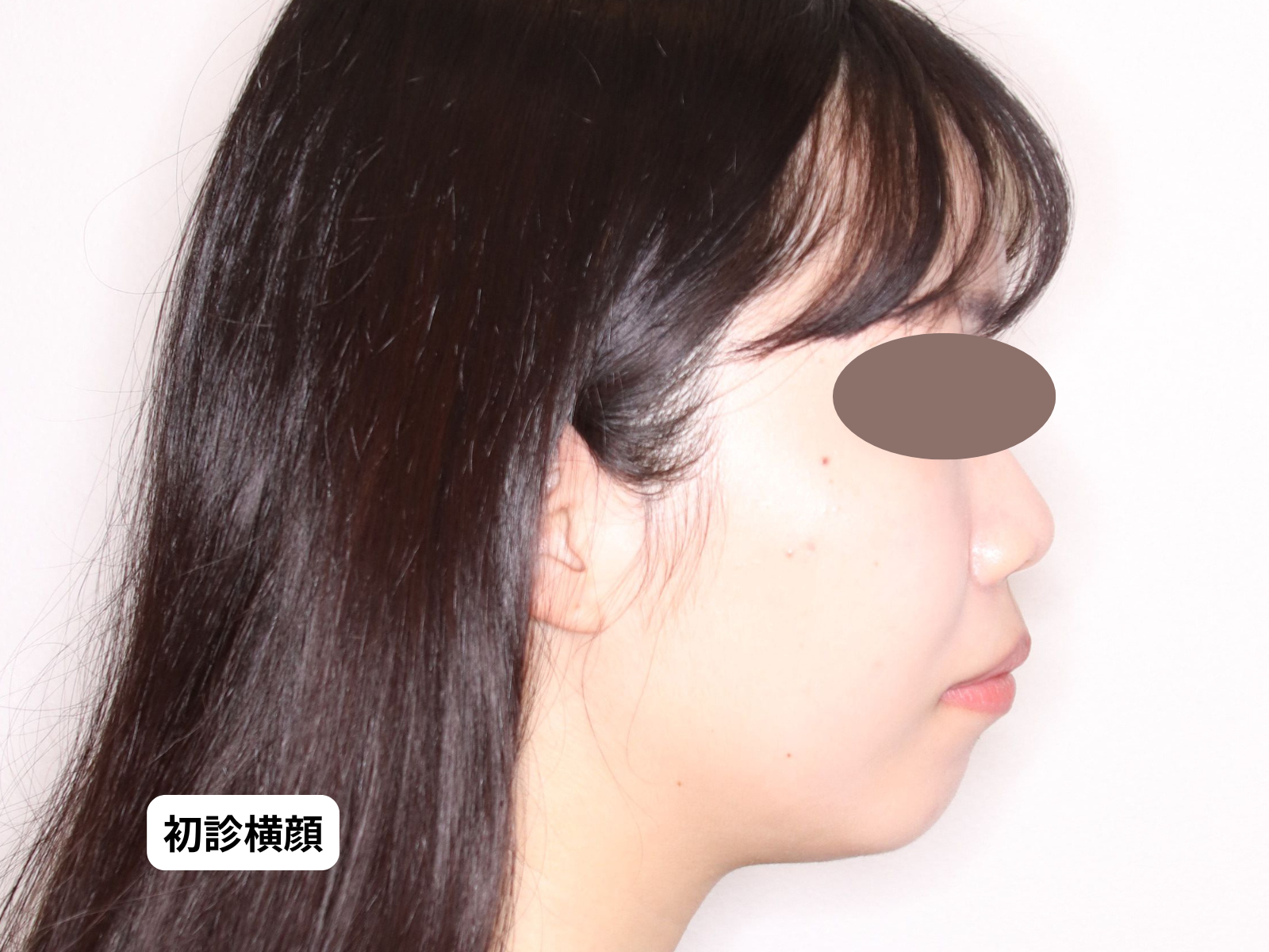 初診時の側貌（79-02）｜奈良の矯正歯科