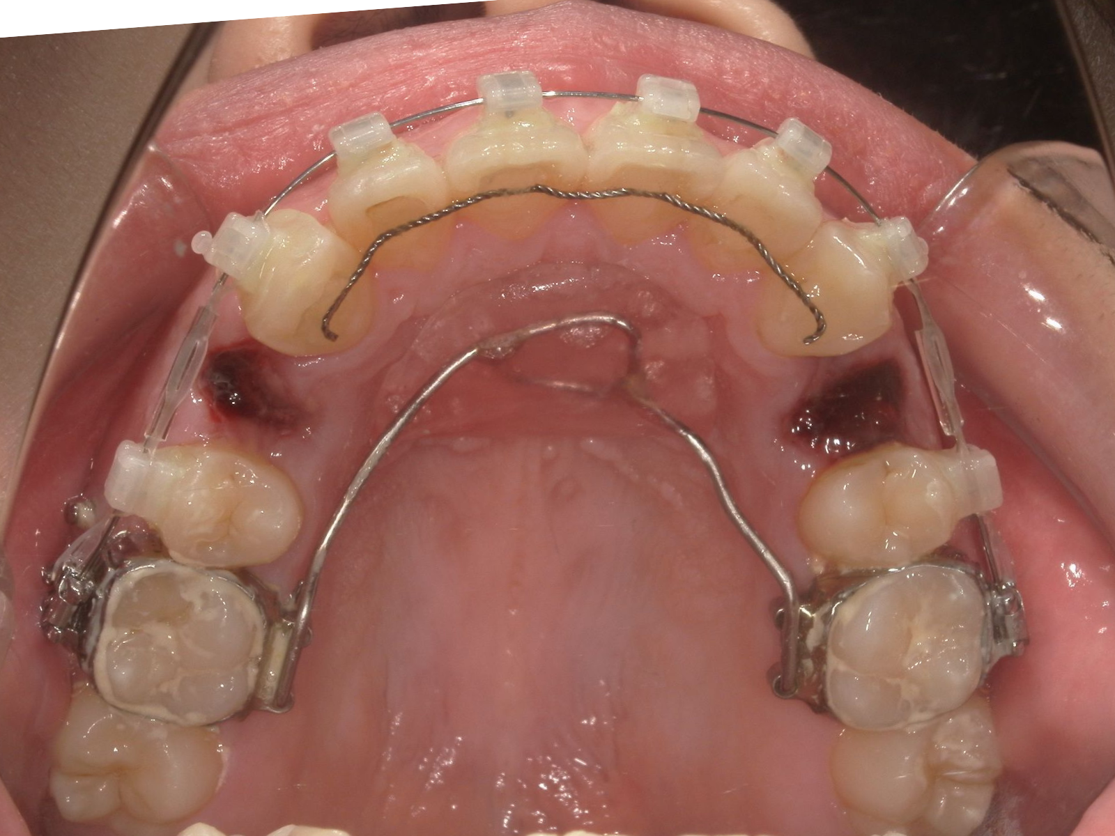 抜歯直後 口腔内（79-05a）｜奈良の矯正歯科