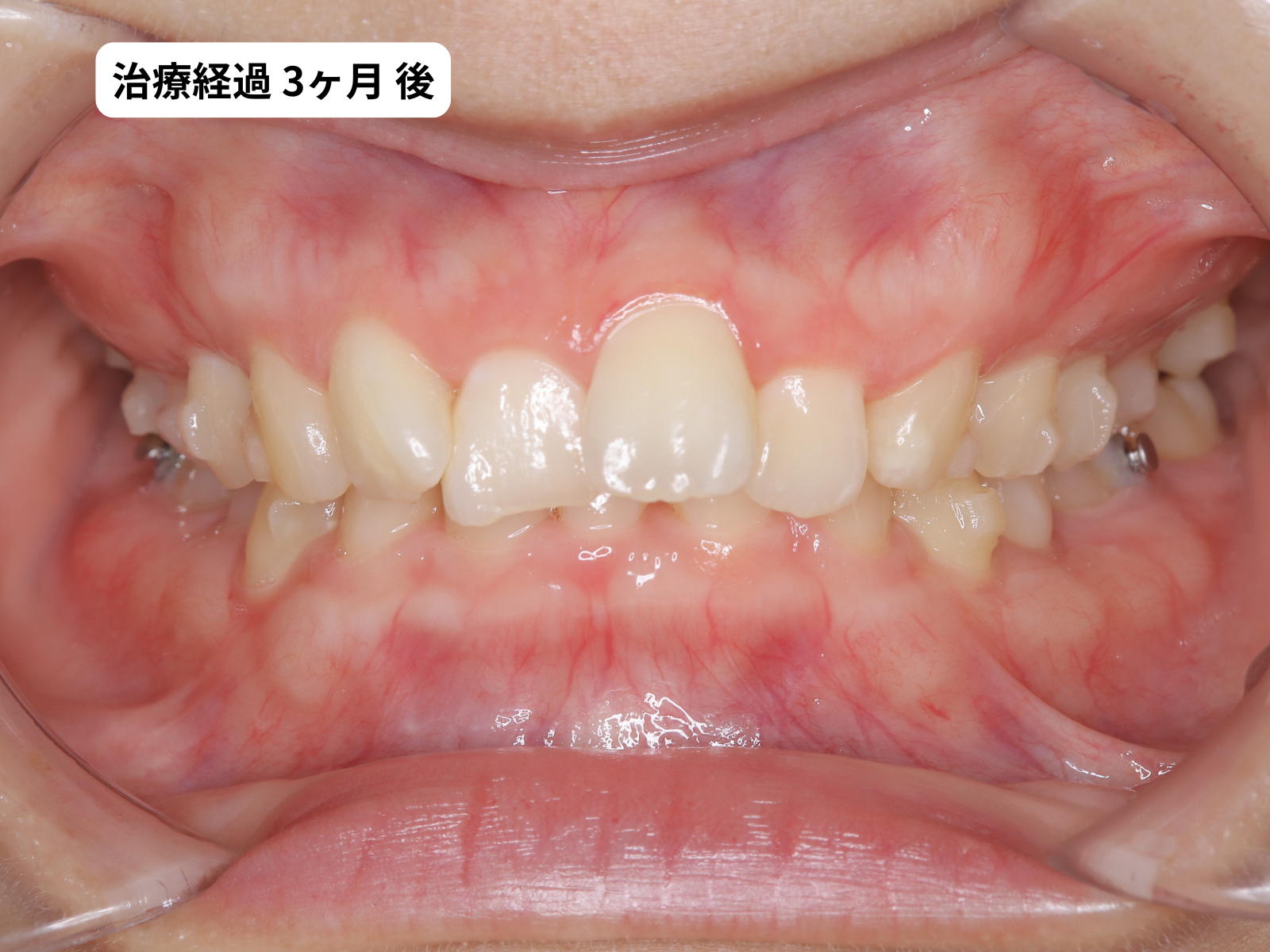 矯正治療3ヶ月目の正面｜過蓋咬合改善経過｜奈良の矯正歯科