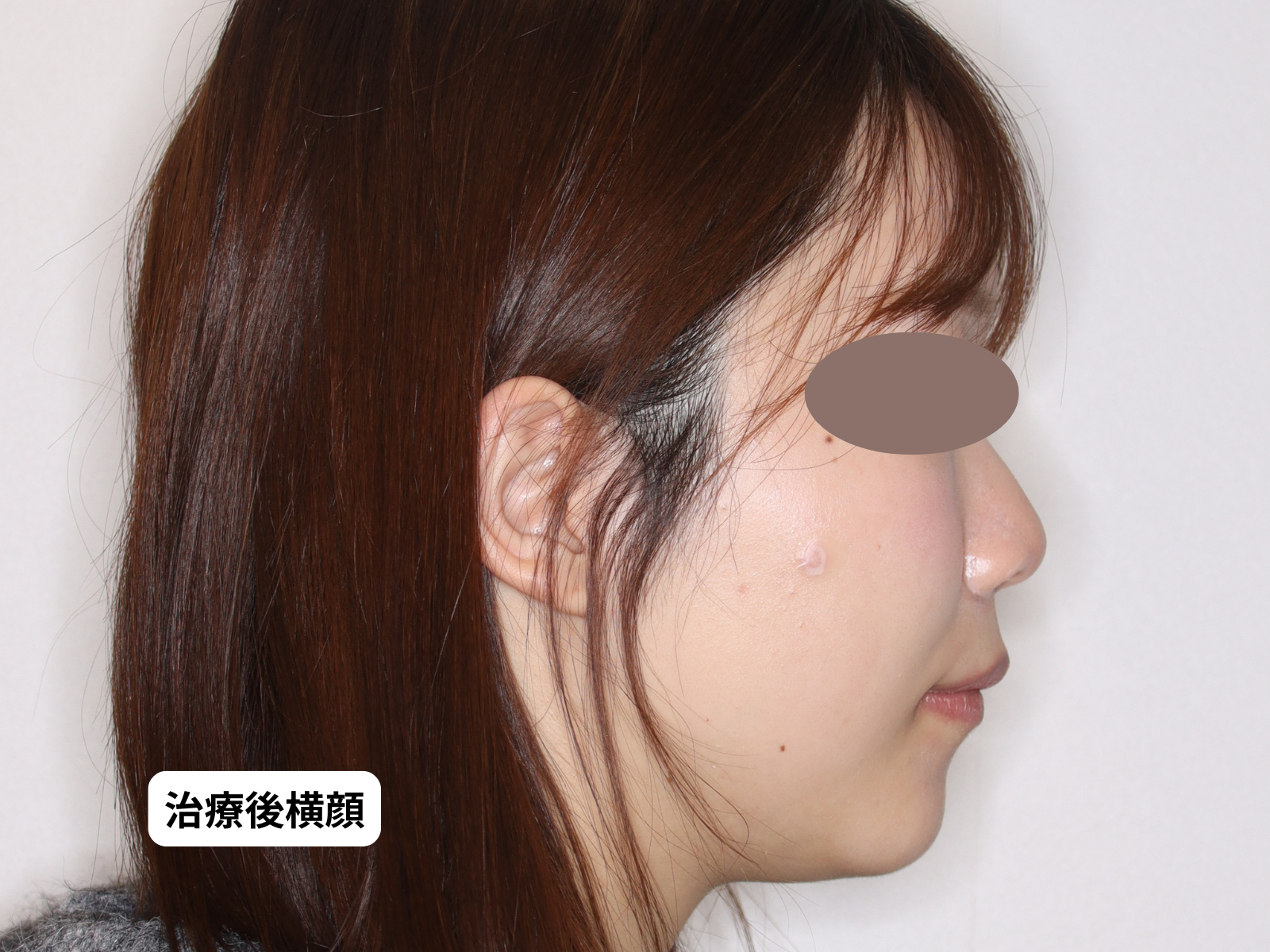 治療後側貌 After（79-BA1b）｜奈良の矯正歯科