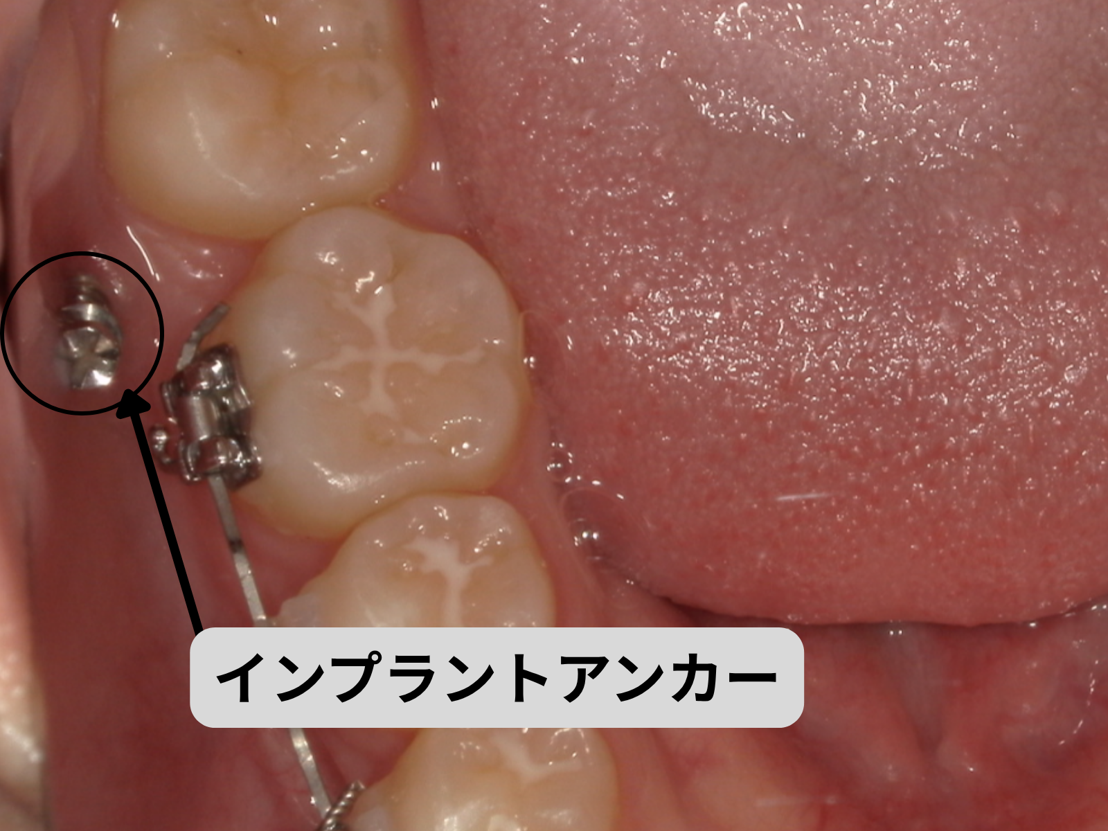 下顎頬側棚（バッカルシェルフ）の位置を上から見た図｜奈良の矯正歯科 氏井矯正歯科クリニック