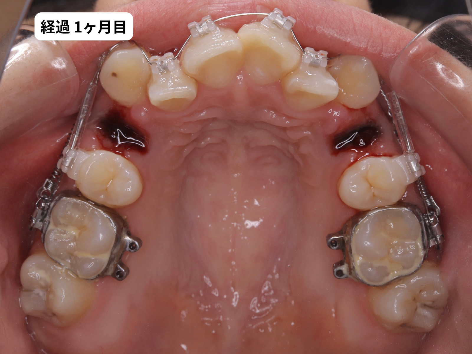 矯正治療1ヶ月目の上顎咬合面｜でこぼこ矯正経過・奈良の矯正歯科
