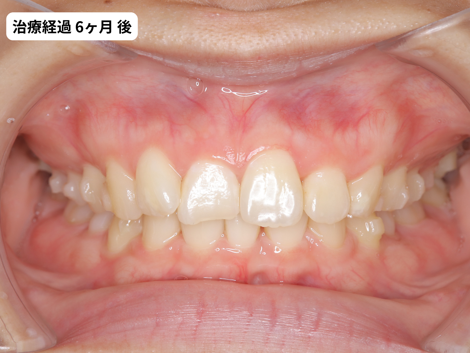 矯正治療6ヶ月目の正面｜過蓋咬合改善経過｜奈良の矯正歯科