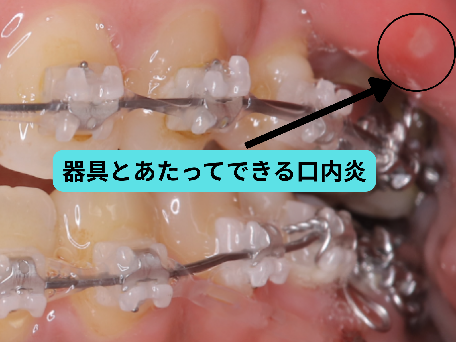 矯正装置の刺激でできた口内炎の口腔内写真
