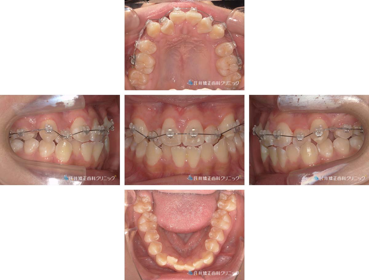 治療中（6ヶ月後）