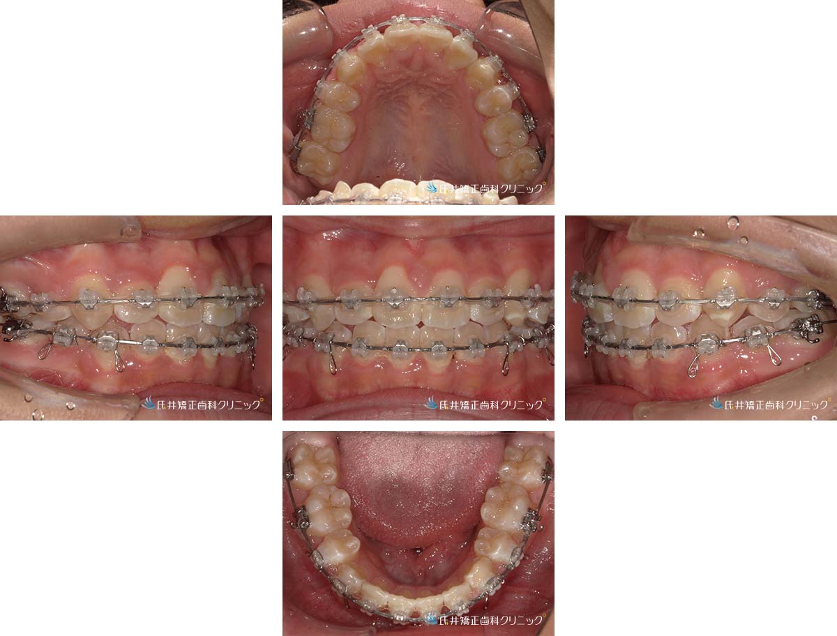 治療中（1年6ヶ月後）