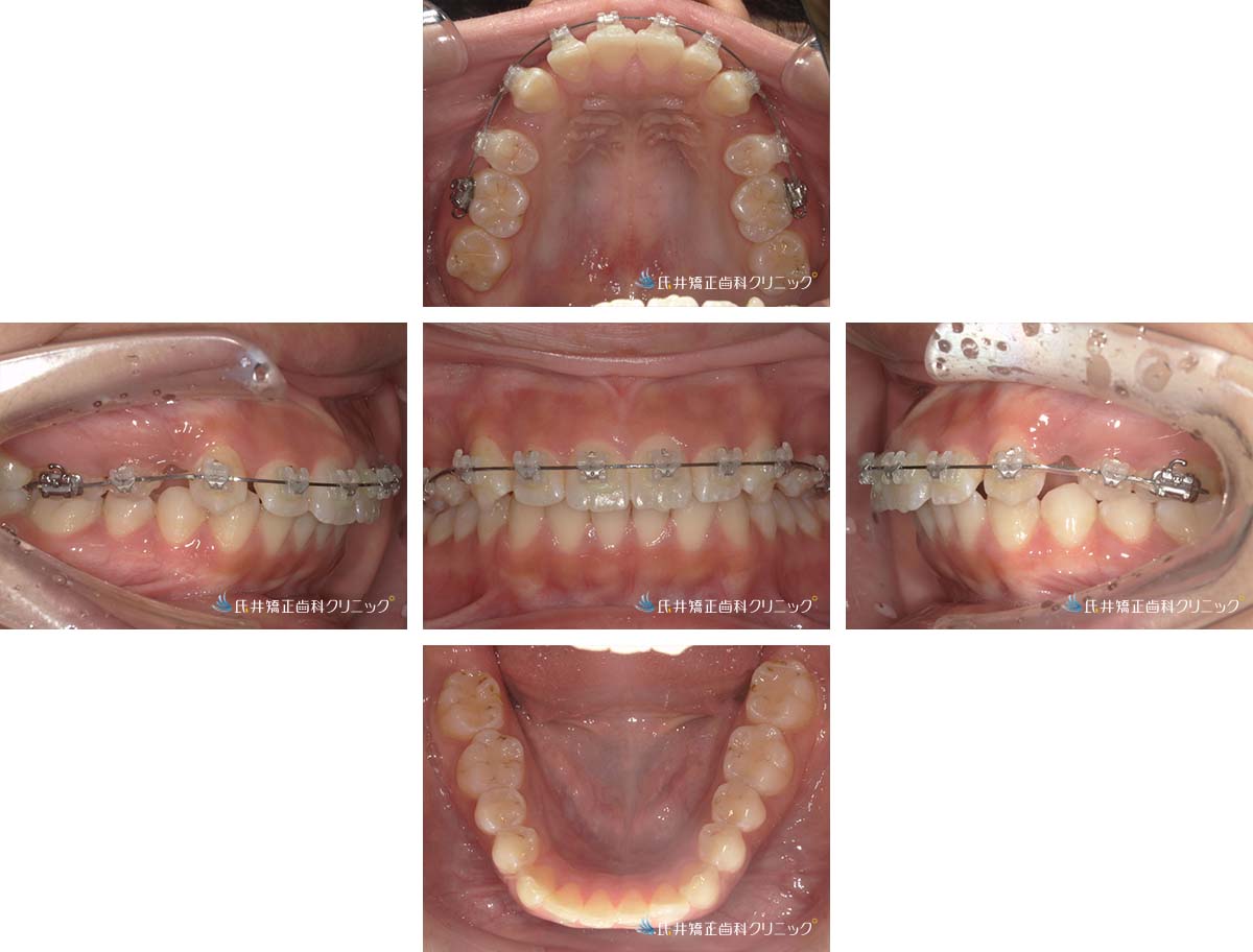 治療中（6ヶ月後）