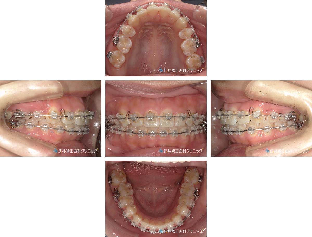 治療中（1年6ヶ月後）