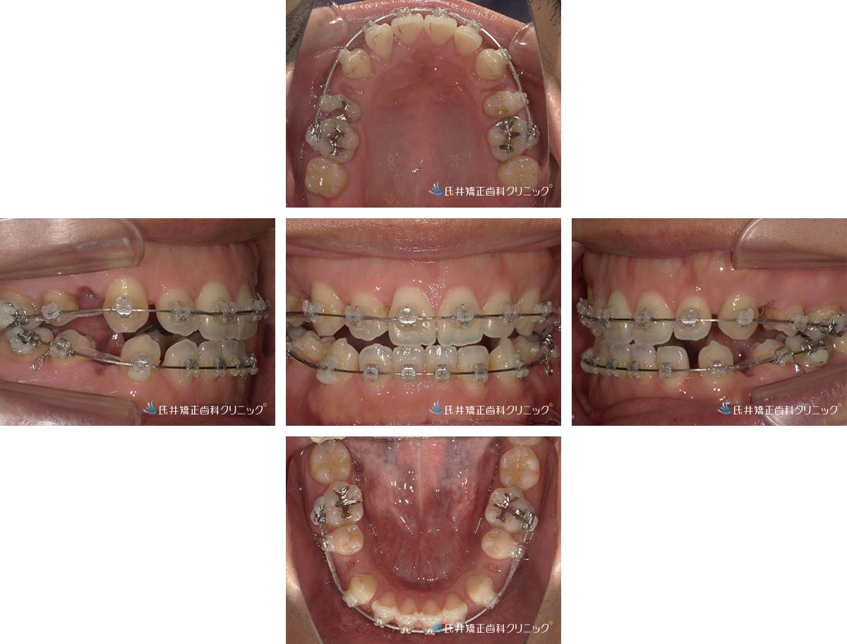 治療中（6ヶ月後）