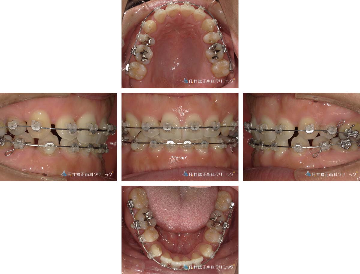 治療中（1年6ヶ月後）