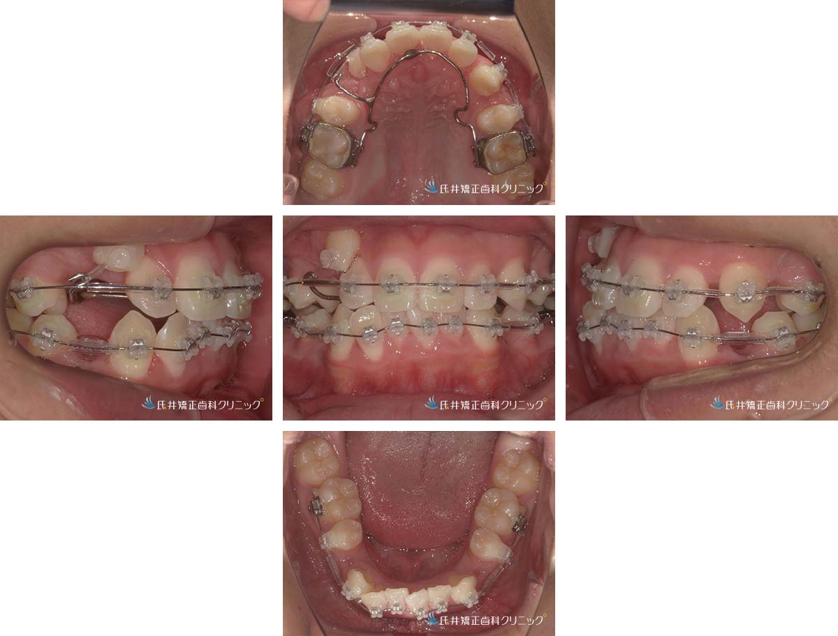 治療中（3ヶ月後）