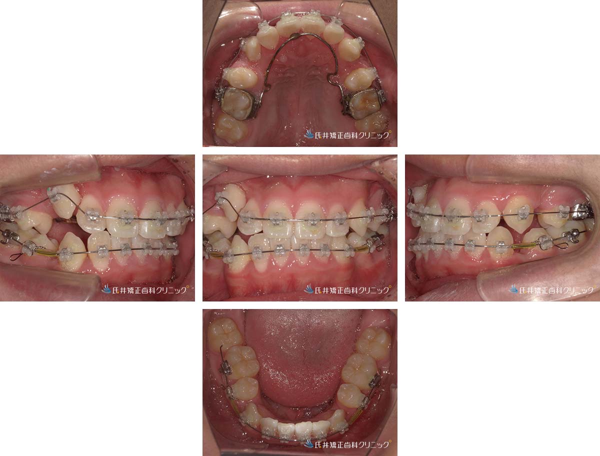 治療中（6ヶ月後）