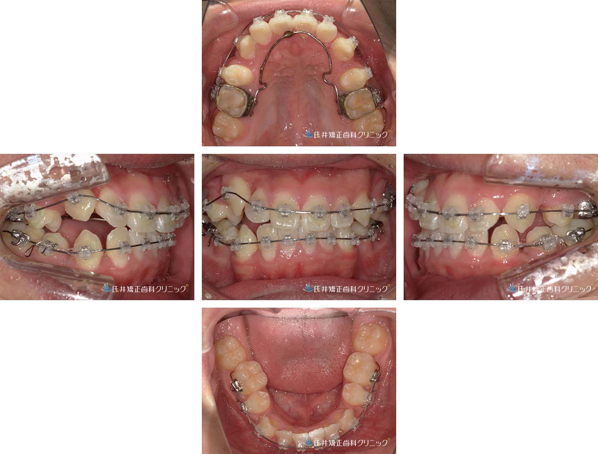 治療中（1年6ヶ月後）