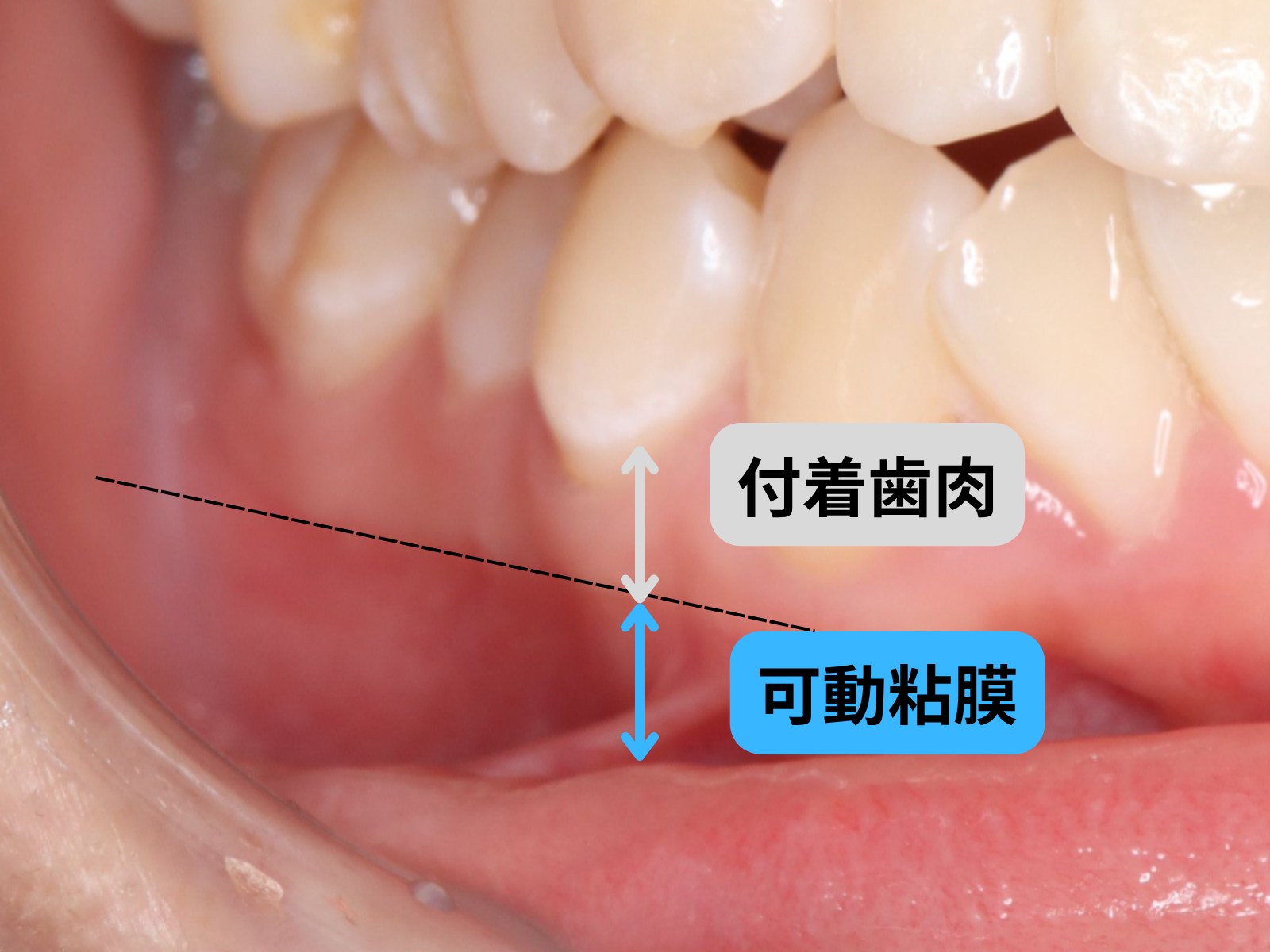 付着歯肉と可動粘膜の違いと境界（MGJ）｜奈良の矯正歯科 氏井矯正歯科クリニック