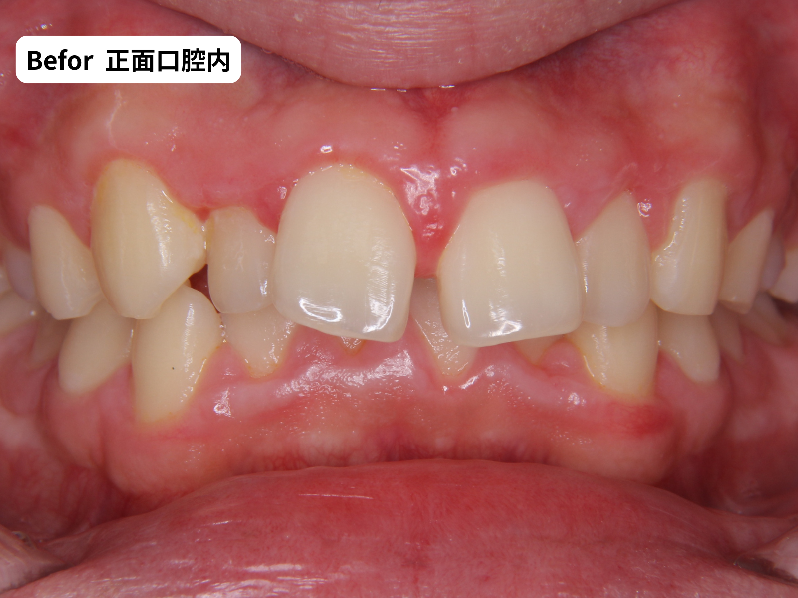 治療前の前歯の真ん中のすき間（正中離開・すきっ歯）