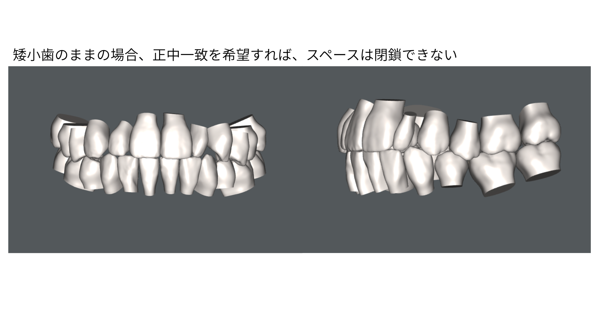 矮小歯のまま矯正で並べ、正中を合わせた予測。矮小歯の両脇にスペースが残る3Dシミュレーション