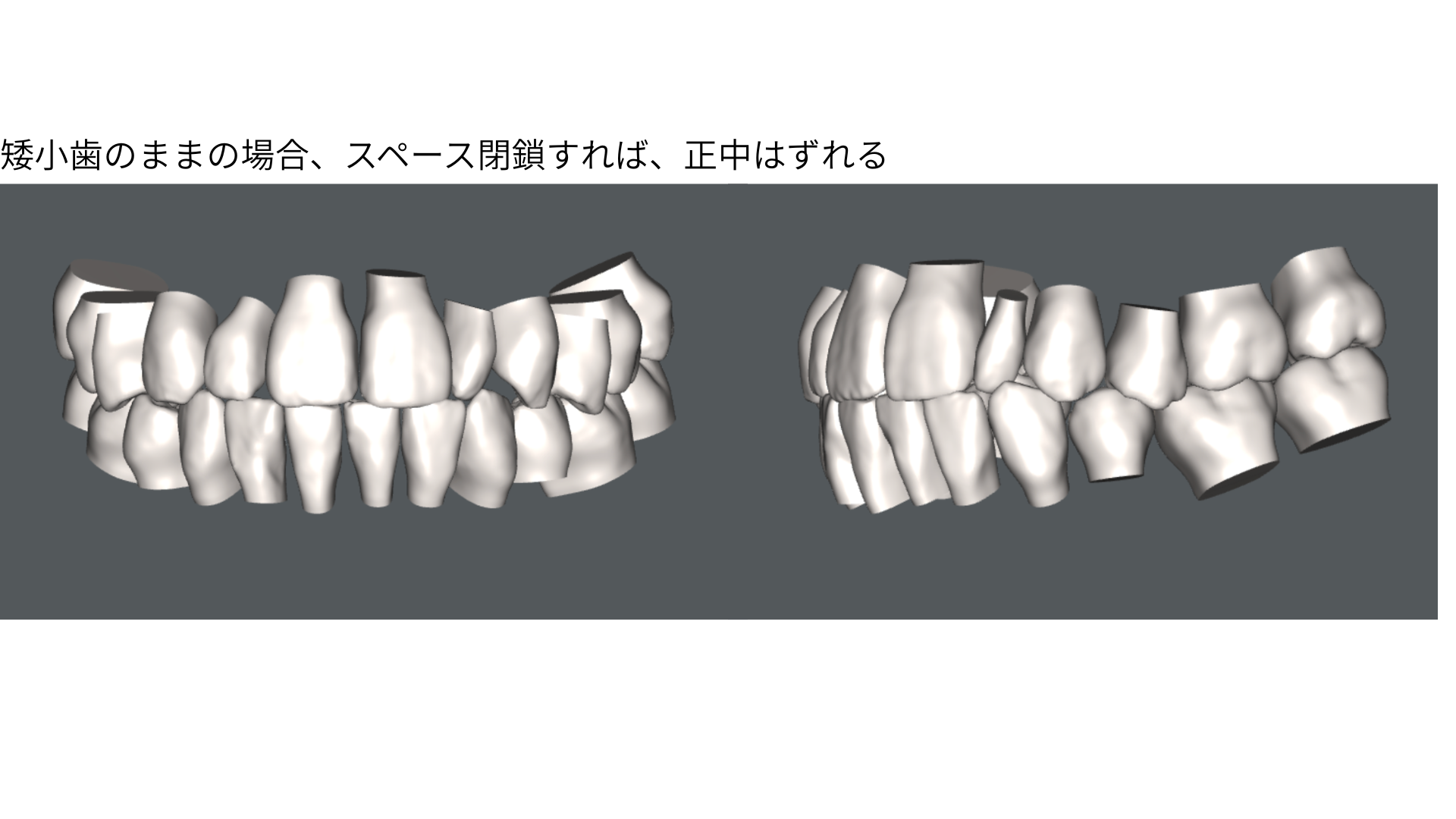 矮小歯のままスペースを閉じた矯正後の3Dシミュレーション。正中(前歯の真ん中)がずれる結果