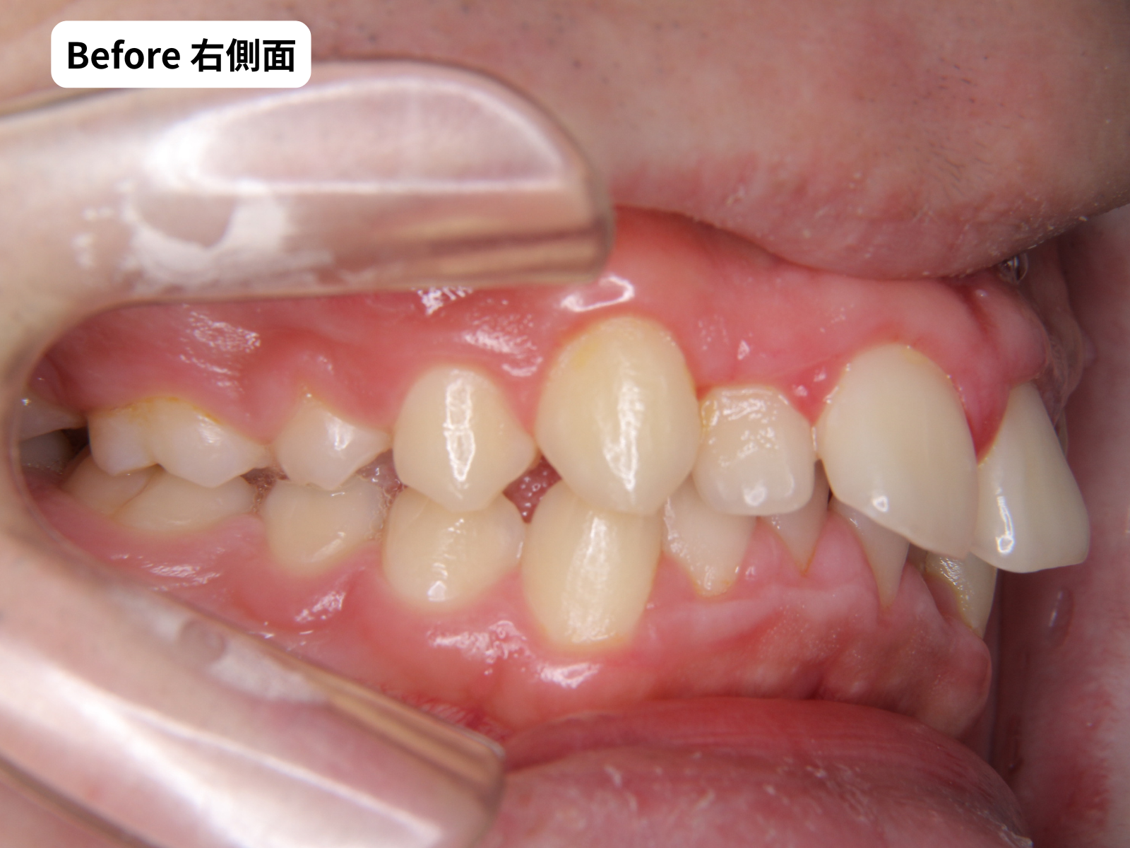 治療前の右側面（前歯が前方へ傾いている）