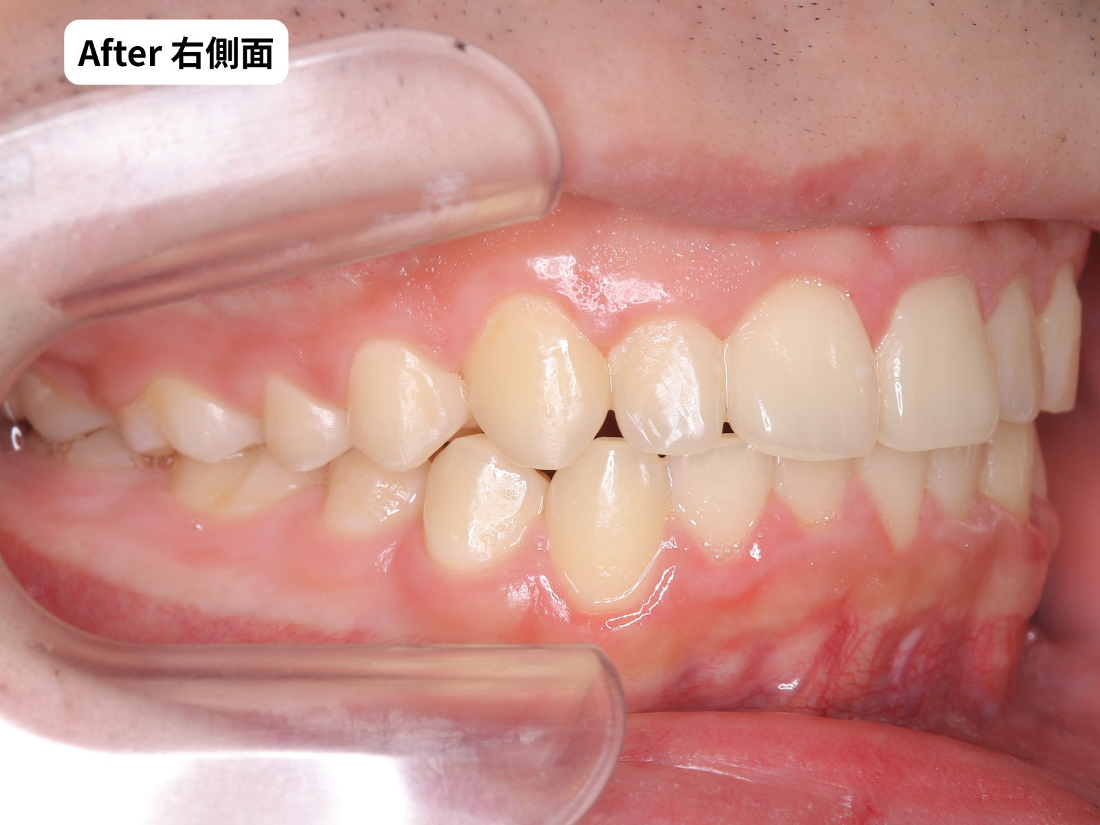 治療後の右側面のかみ合わせ