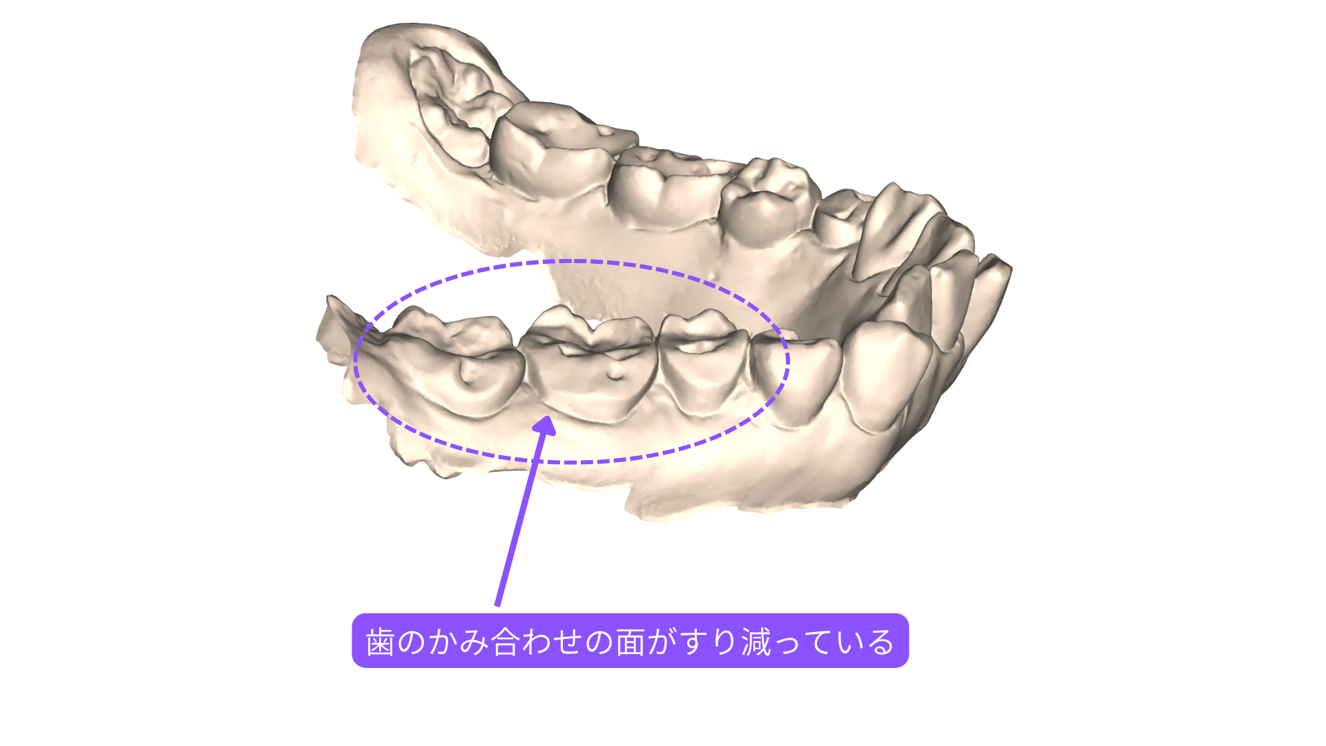奥歯のかみ合わせの面がすり減っている口腔内スキャン。噛みしめや食いしばりで咬合面が平らにすり減った状態
