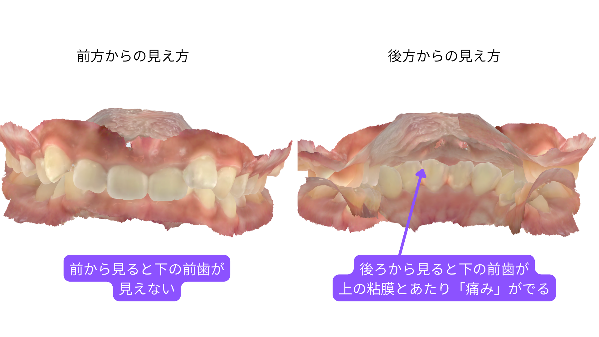 過蓋咬合の口腔内。前方から見ると下の前歯が見えず、後方から見ると下の前歯が上あごの粘膜に当たっている様子