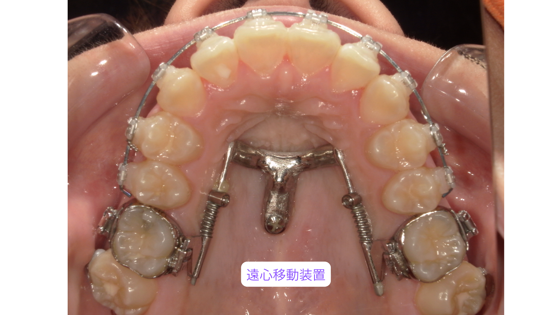 上あごの奥歯を後方へ動かす上顎遠心移動の装置を設置した口腔内写真
