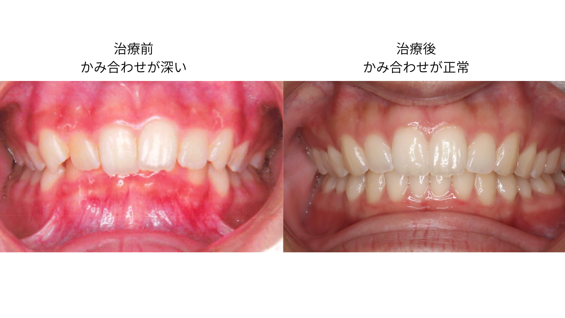 正常な噛み合わせと過蓋咬合の比較。上下前歯のかぶさりの違いが分かる横からの口腔内写真