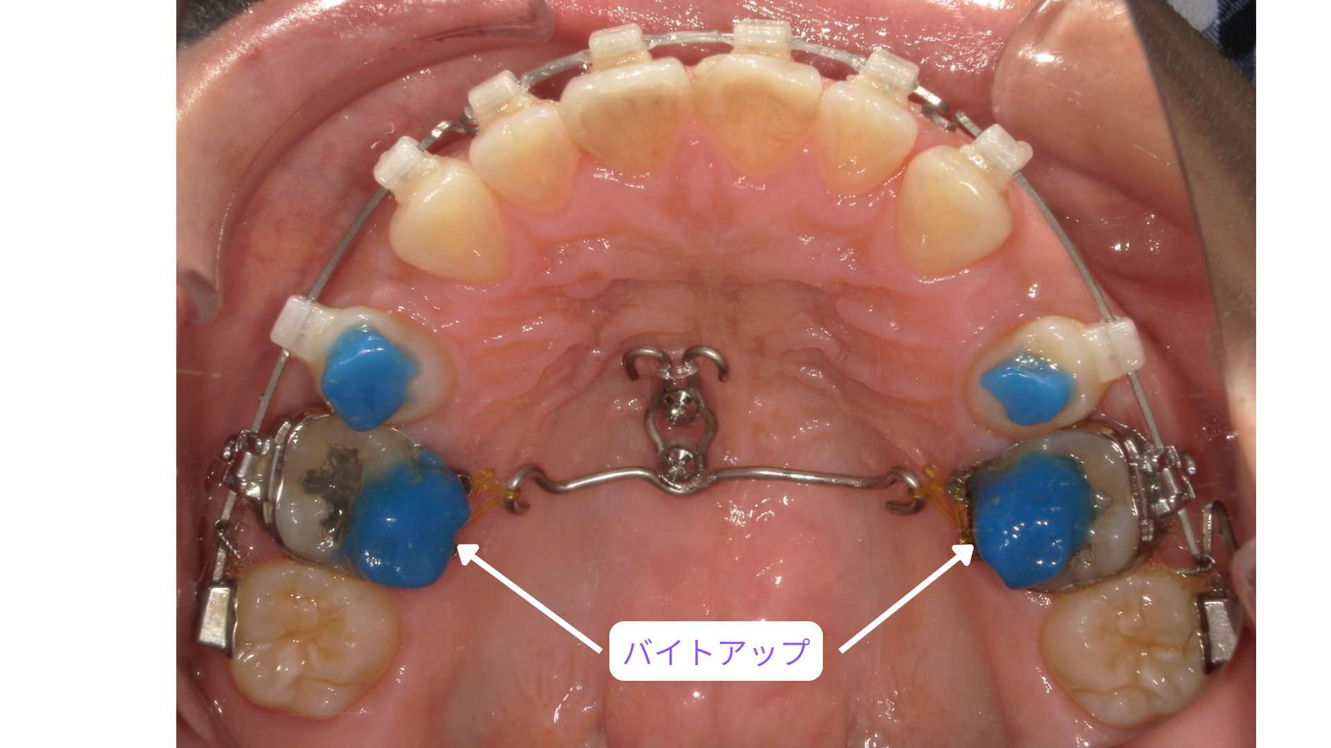バイトアップの口腔内写真。奥歯にレジンを付けて噛み合わせを一時的に持ち上げた状態