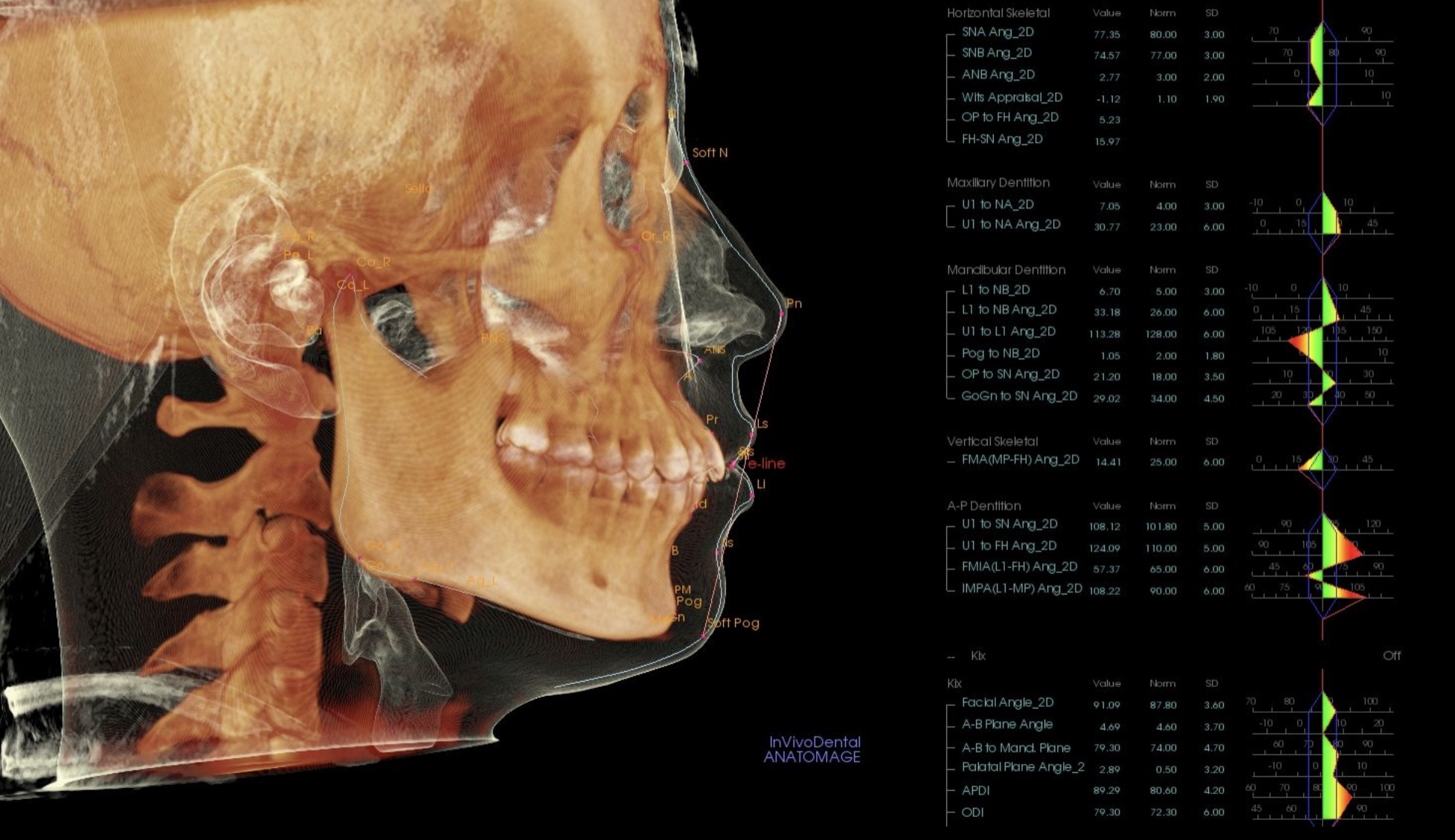 治療前のセファロ分析：頭部の3D画像と各計測値