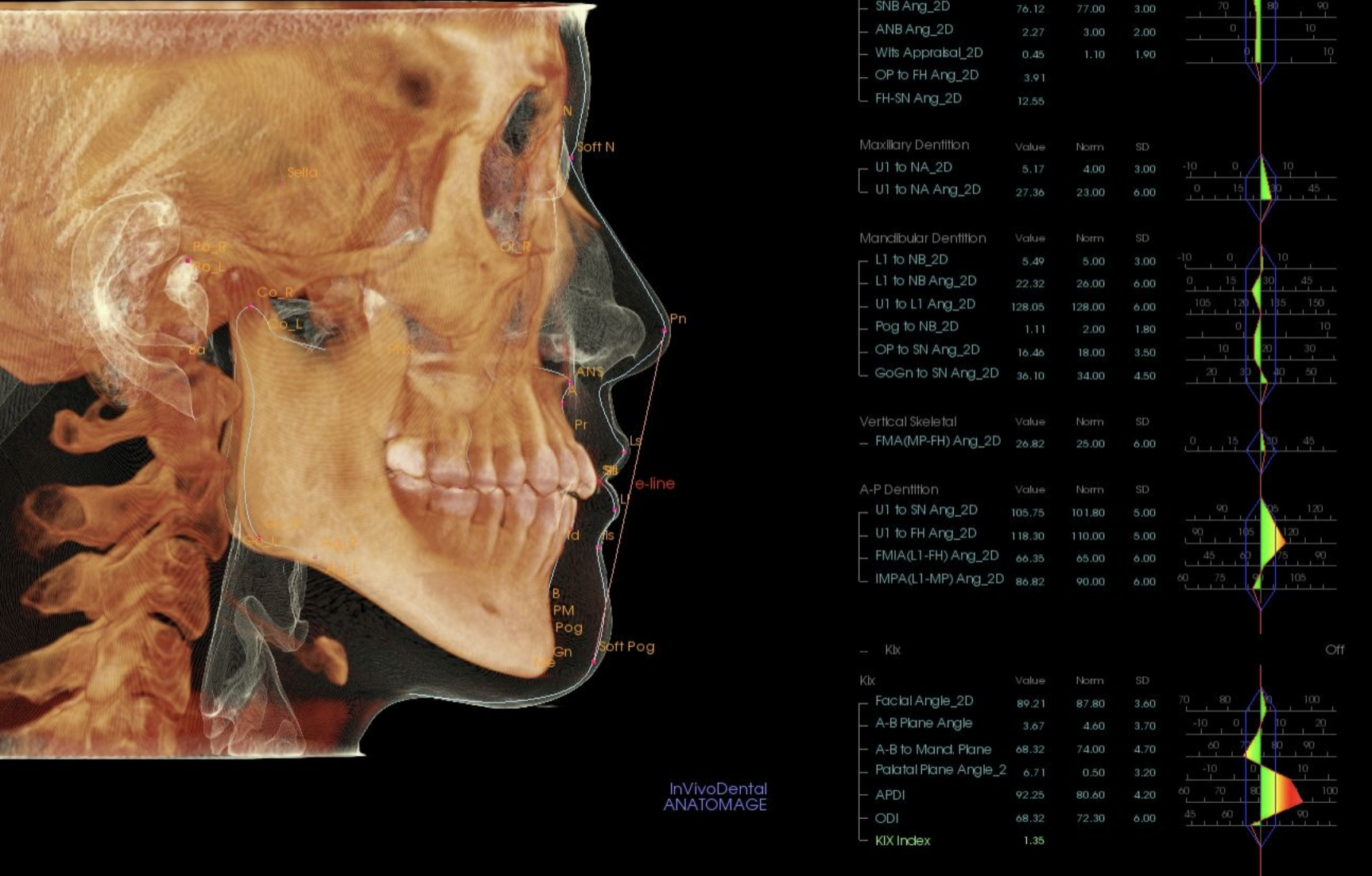 治療前のセファロ分析：頭部の3D画像と各計測値