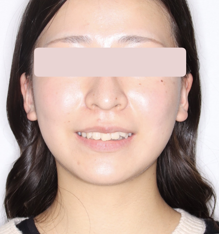 治療前の笑顔：前歯のでこぼこと真ん中のずれが見える状態