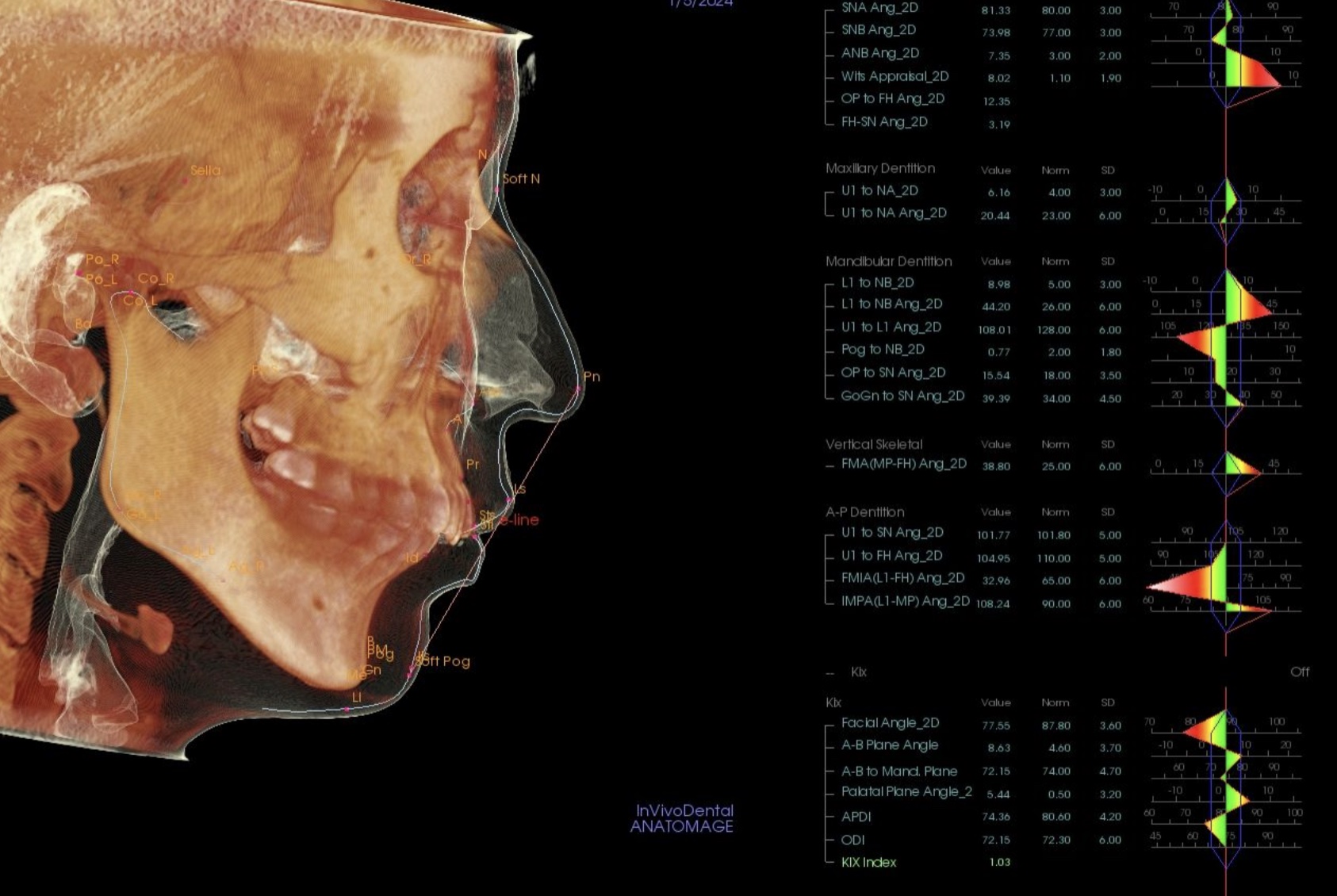 治療前のセファロ分析：頭部の3D画像と各計測値