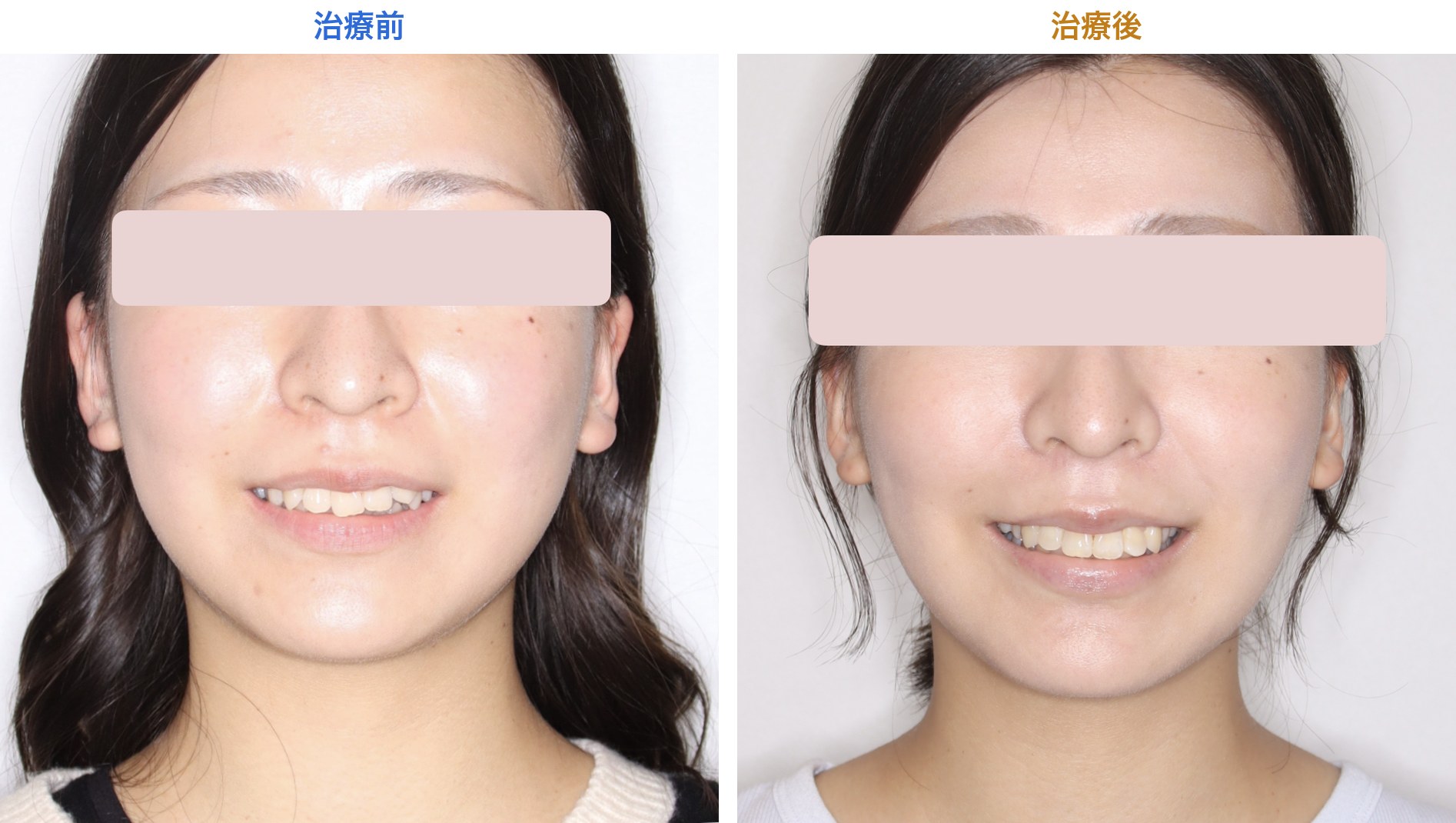治療前と治療後の笑顔の比較：前歯の重なりがなくなった歯並び
