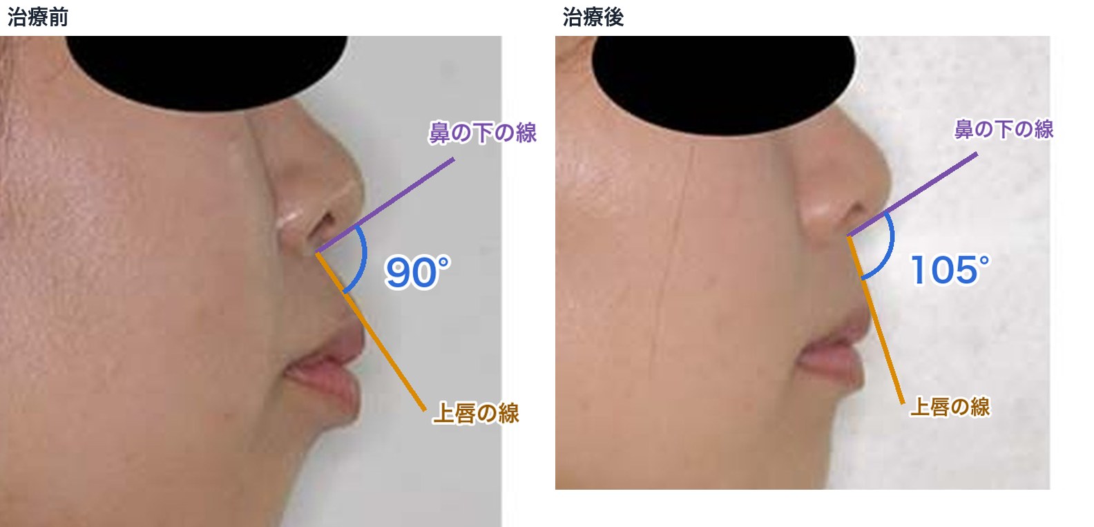 症例21の鼻唇角。治療前は鼻の下の線と上唇の線の角度が90度で、上唇が前に倒れている。治療後は105度に開き、上唇が起き上がっている