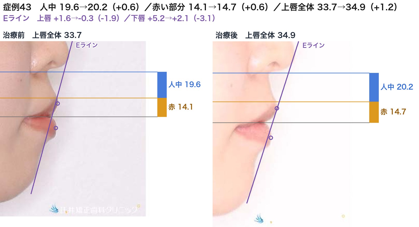 症例43の治療前後の横顔。口元はEラインの内側へ下がったが、人中と赤い部分の長さはほとんど変わっていない