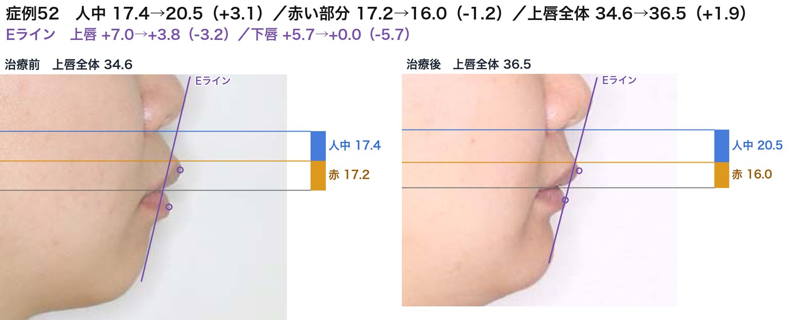 症例52の治療前後の上唇。青が人中、オレンジが唇の赤い部分。こちらも同じ動き。上唇が立って、めくれが取れた