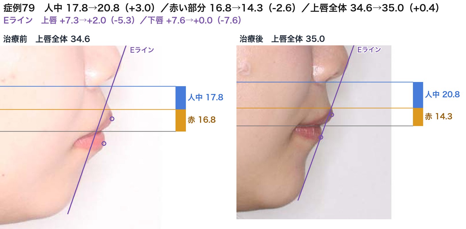 症例79の治療前後の上唇。青が人中、オレンジが唇の赤い部分。上唇全体は同じまま、赤い部分が減って人中が長くなった