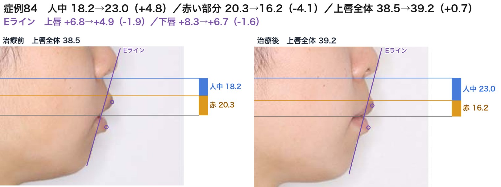 症例84の治療前後の上唇。青が人中、オレンジが唇の赤い部分。上唇全体の長さはほぼ同じ。赤い部分が短くなったぶん、人中が長くなった