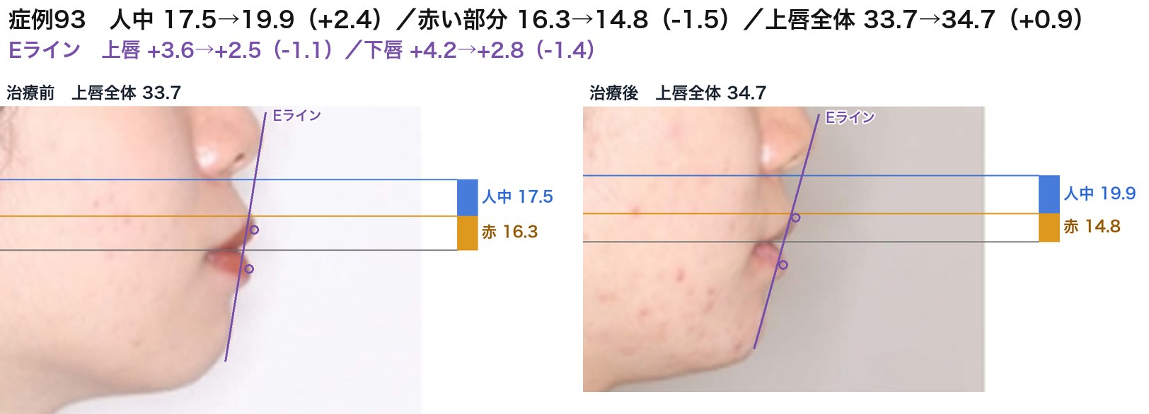 症例93の治療前後の上唇。青が人中、オレンジが唇の赤い部分。変化は小さめだが、同じ向きの動き