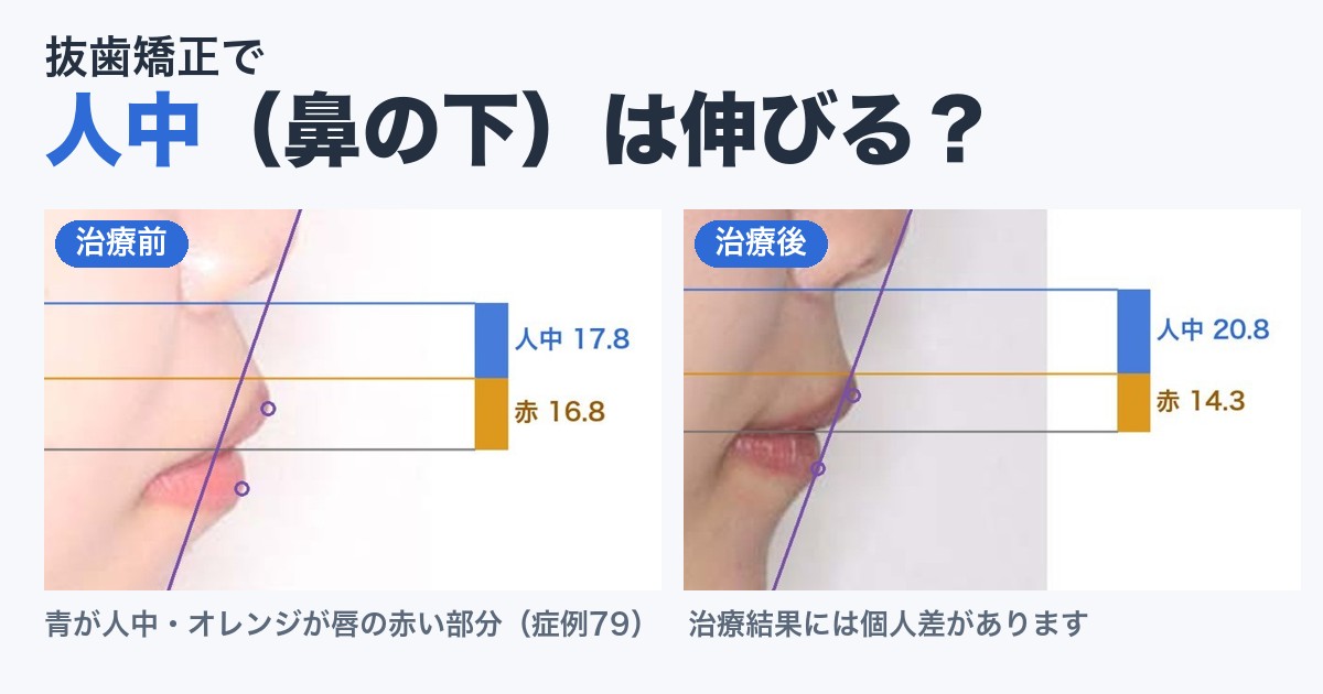 抜歯矯正で人中（鼻の下）は伸びる？症例79の治療前後の上唇。青が人中、オレンジが唇の赤い部分